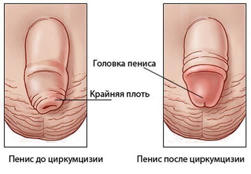 amputarea penisului