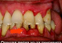 Ce trebuie făcut dacă gingia iese din dinte?