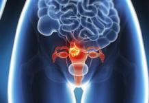 Durerea în mioamele uterine: cauze ale diagnosticului și metodelor de tratament