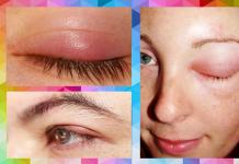 อาการบวมใต้ตา: ภาพถ่ายสาเหตุและการรักษาอาการบวมใต้ตาเป็นสาเหตุในผู้หญิง