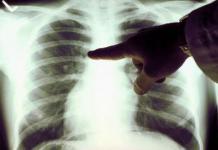 Cât timp poți trăi cu cancer pulmonar: etape și statistici