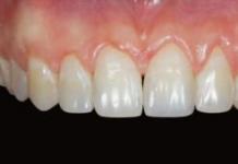 Скільки корінних зубів знаходиться в кожній щелепі